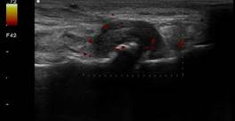 Echografisch beeld van breukje in een bot