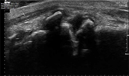 Echografisch beeld van gewrichtsartrose